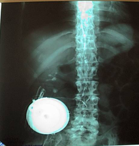 ακτινολογική εικόνα τοποθετημένης αντλίας μπακλοφένης