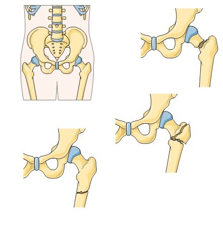 hip fractures